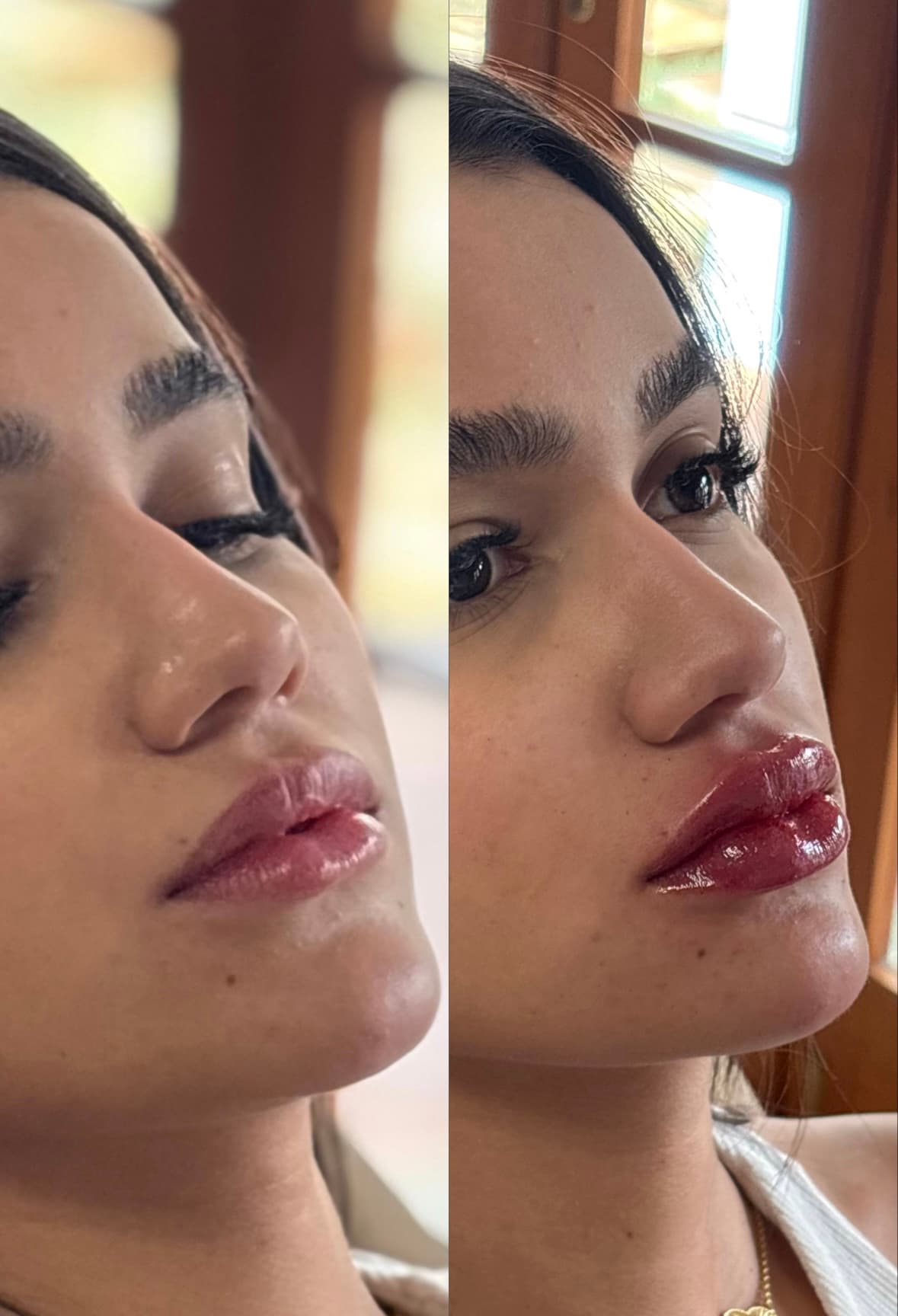 Antes e depois de preenchimento labial