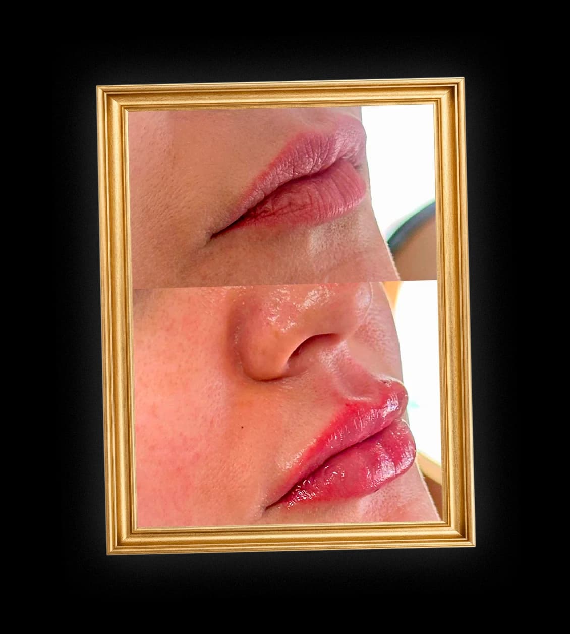 Resultado do preenchimento labial