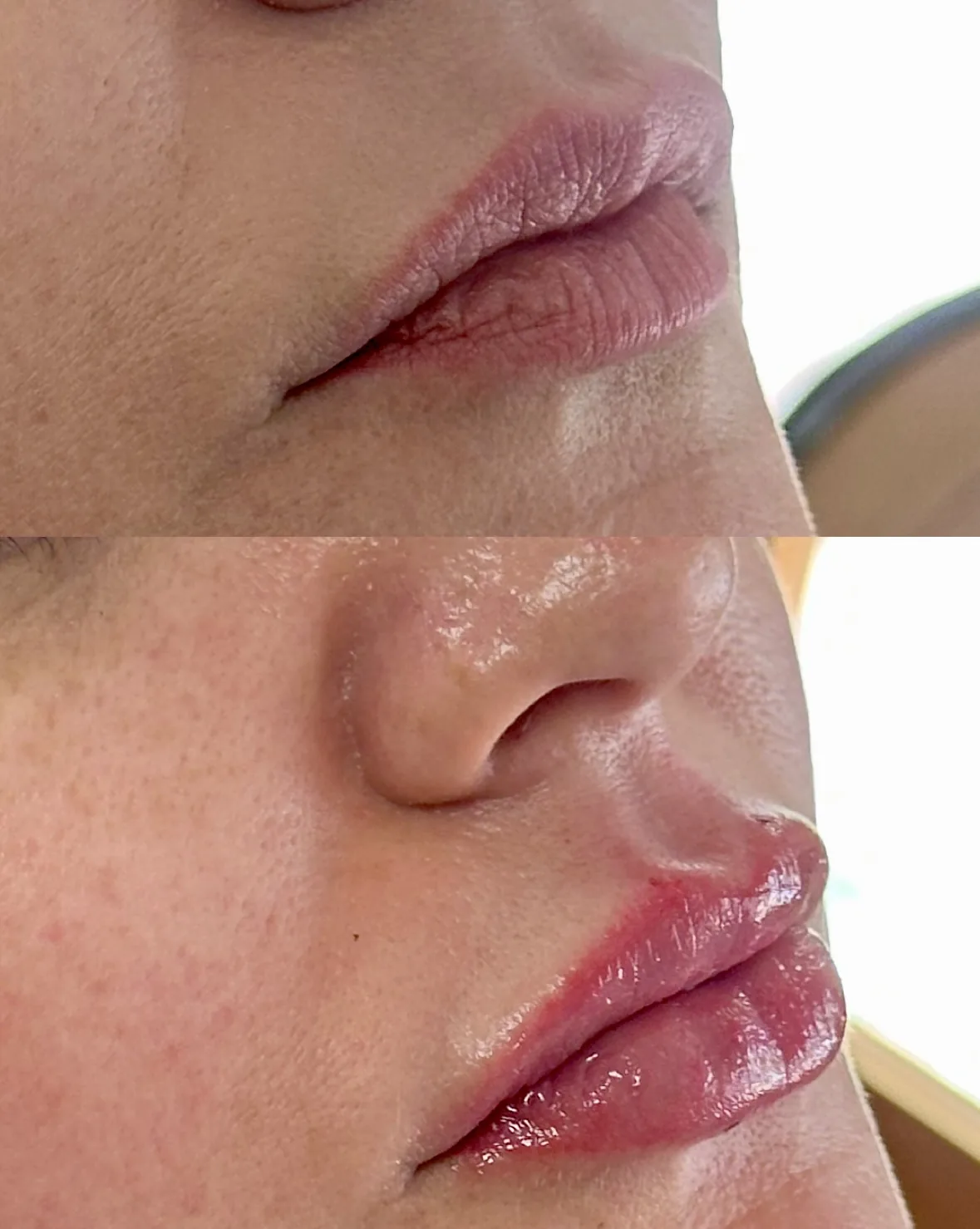 Preenchimento Labial